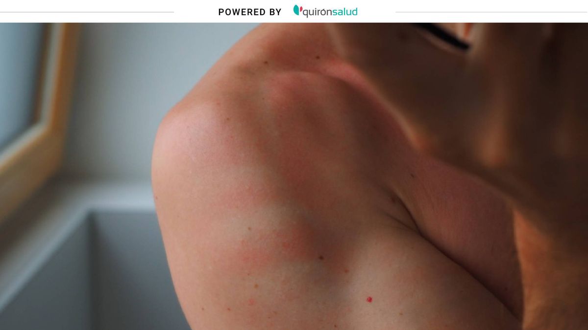 eczema por sol mik a vörös foltok a testen a karok hátsó részén