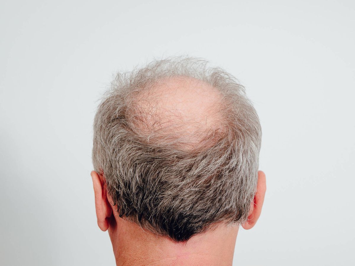 Así evoluciona la caída del pelo en los hombres (y cuál es la década clave)