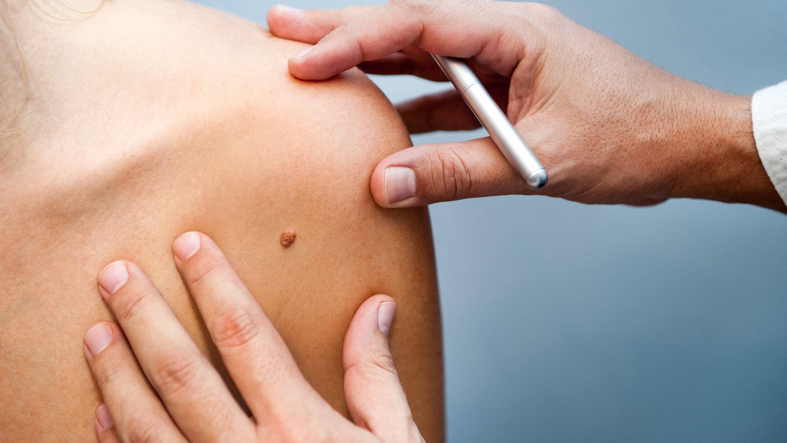 Salud: Síntomas del melanoma que no deberías ignorar (y lo haces a menudo)