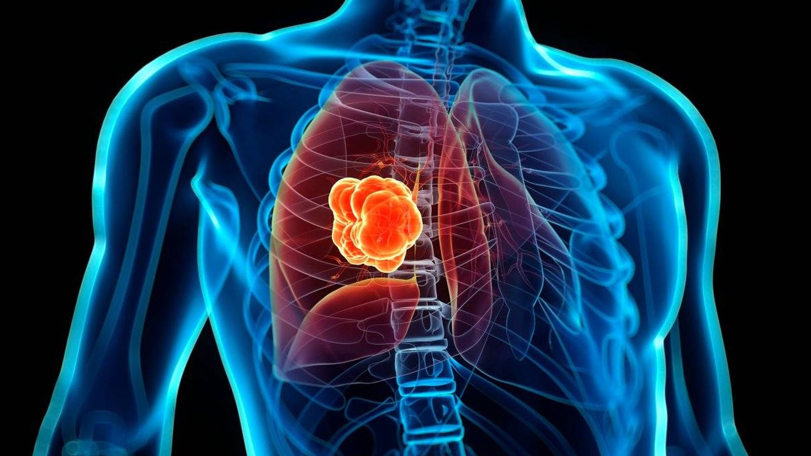 Lumakras, pastila care tratează cancerul pulmonar, a primit aprobarea FDA