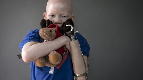 La segunda oportunidad de los niños albinos mutilados de Tanzania 