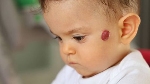 Manchas rojas desde el nacimiento: los hemangiomas infantiles