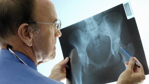 ¿Es la osteoporosis una enfermedad también masculina?