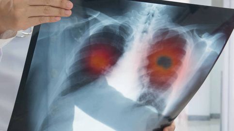 Un estudio español cambia el paradigma contra el cáncer de pulmón y multiplica su curación
