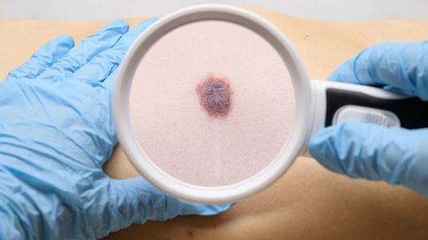 Descubren la pieza que faltaba para entender el misterioso crecimiento de los melanomas
