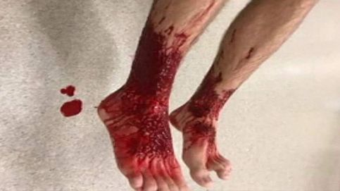 'Piojos de mar' desgarran la piel de un joven australiano