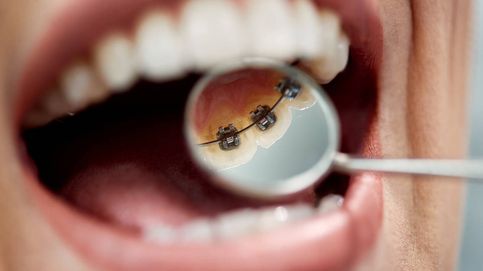 ¿Cómo mejoran las recesiones gingivales gracias a un tratamiento de ortodoncia?