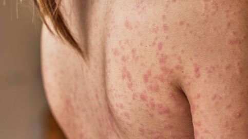 Un nuevo tratamiento oral para la dermatitis atópica llega a España: Ayudará a quienes aún no han encontrado alivio