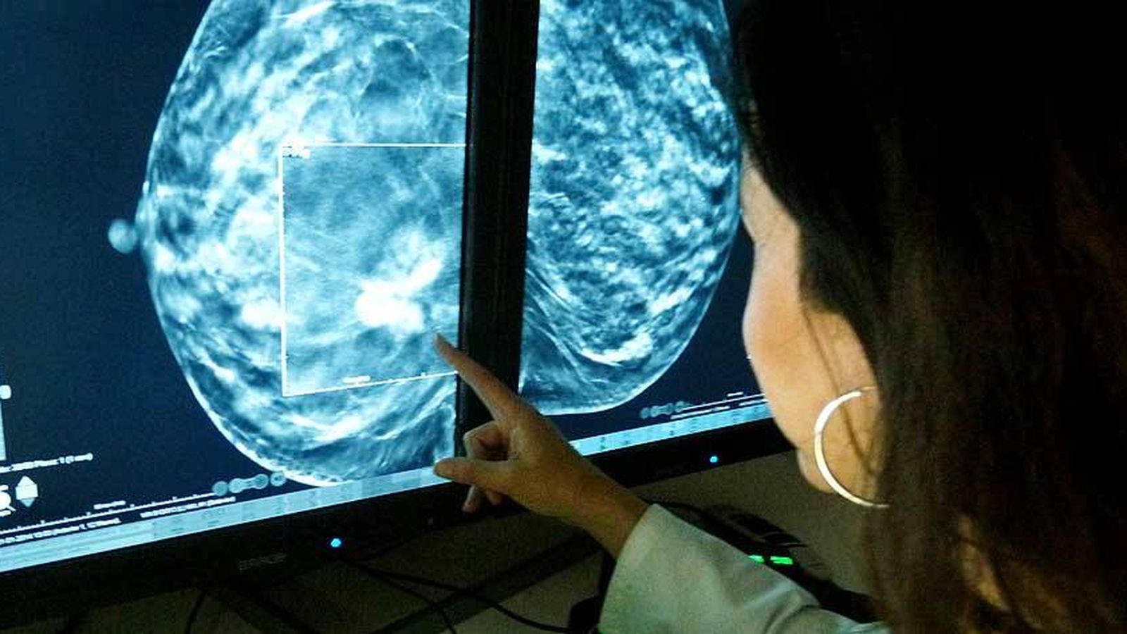 Resultado de imagen para mamografia