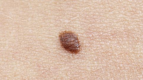 ¿Cómo personalizar nuestras opciones para prevenir el melanoma?