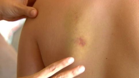 Un niño hemofílico recibe una paliza por parte de seis compañeros de su instituto