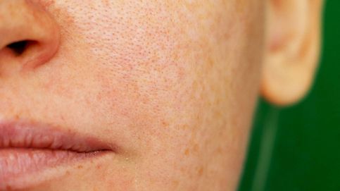 La difícil tarea de eliminar las manchas de la piel: 3 consejos del dermatólogo 