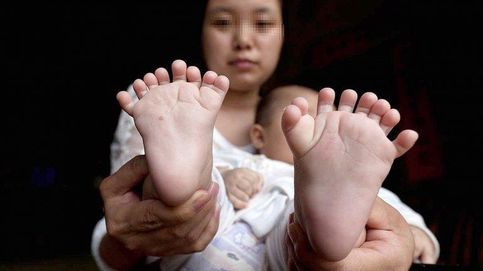 Un niño chino nace con 31 dedos y sus padres piden ayuda para su operación