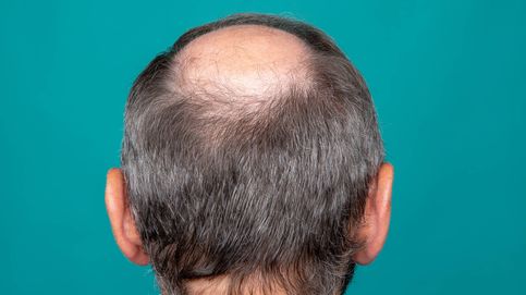 ¿Sirve de algo la pastilla milagrosa contra la alopecia?